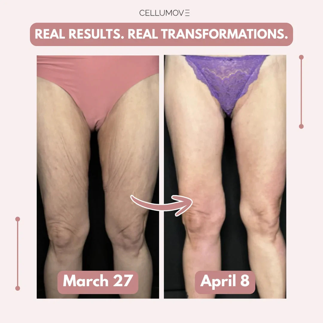 Firmer, smoother legs in 14 days — for women tired of saggy skin holding them back