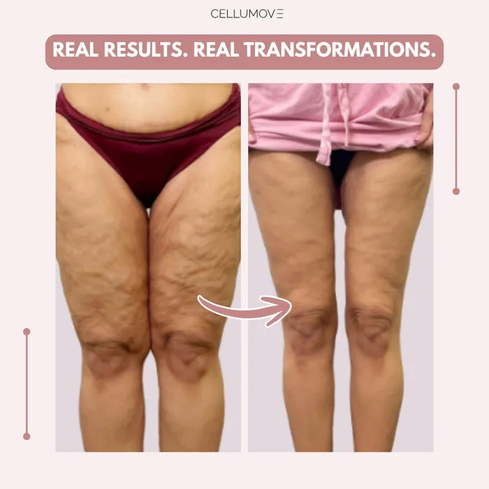 Cellumove 3D Legging – Say goodbye to lipoedema pain and swelling naturally