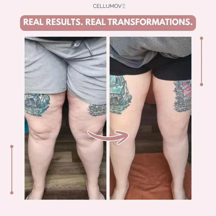Cellumove 3D Legging – Say goodbye to lipoedema pain and swelling naturally