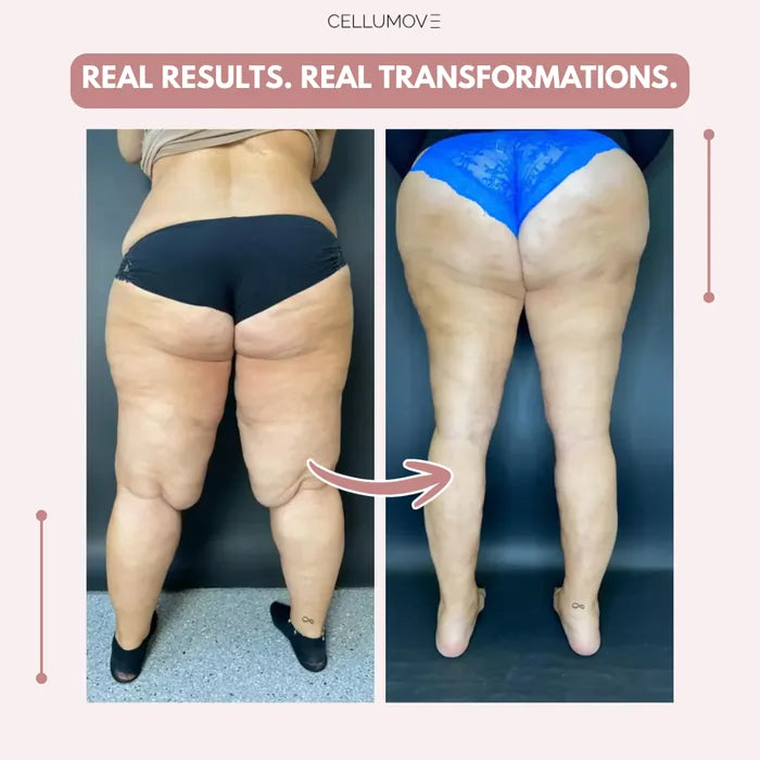 Cellumove 3D Legging – Say goodbye to lipoedema pain and swelling naturally